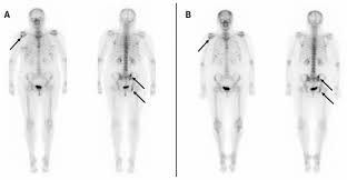 bone metastasis and prostate cancer. Osseous Sarcoidosis Mimicking Metastatic Breast Cancer Cmaj