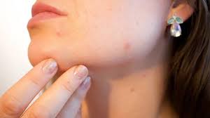 Banyak orang dengan kondisi kulit berminyak menghindari sunscreen, karena penggunaan sunscreen yang tidak tepat dapat membuat kulit semakin berminyak dan berjerawat. Kumpulan Sunscreen Untuk Kulit Berjerawat Moiamor