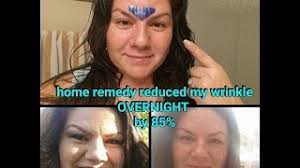 HOW-TO overnight get rid of wrinkle between eyes