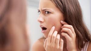 El Motivo Por El Que Sale Acne Durante La Regla Y Como Prevenirlo