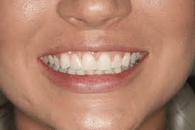 How to make a dental flipper at home. The Flipper A Temporary Tooth Cosmetic Dentistry