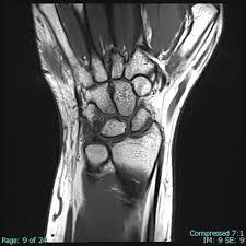 Ulnar Impaction Syndrome - Physiopedia
