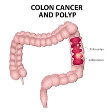 Image result for Colonic Polyp