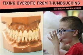 Thumbsucking which pushes the upper teeth and upper jaw forward and the lower jaw backward. How To Fix Overbite From Thumbsucking Orthodontic Braces Care