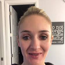 The Perfect Derma Peel day 6, #facialartinstitute #botox #okcesthetician  #dermaplaning #theperfectpeel #dermalfillers #beauty #microneedling  #vampirefacial #bellafill #voluma #juvaderm #chemicalpeel ...