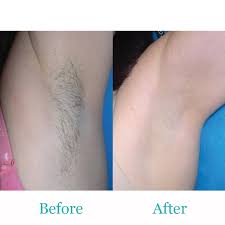 The laser inhibits the hair's ability to grow without disrupting. Hair Removal Pain Free Fort Myers Bonita Springs