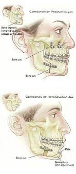 Does blue shield cover jaw surgery. Orthognathic Surgery