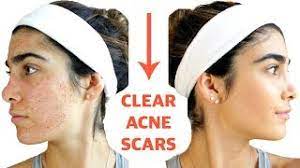 It gives wonderful feeling of clean and taut skin. Clear Acne Scars Fast Diy Face Masks That Work Youtube