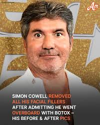 AGT" star Simon Cowell REMOVED HIS FACIAL FILLERS.😳 His transformation is  in the comments below.👇👇👇
