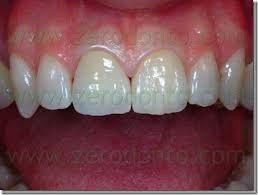 Brilliance boost, luxe glamorous white, radiant mint whitening Gold Ceramic Vs Zirconia Dental Crowns Zerodonto Dentistry In Blog