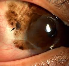 Image result for conjunctival melanoma
