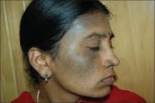Qyag5 Q Switched Nd Yag Laser Treatment Of Nevus Of Ota An Indian Study Of 50 Patients Scienceopen