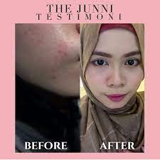 Bisa menyebabkan kanker, ini bahaya menggunakan skincare secara berlebihan. Fatihatul Zahara On Twitter Our Feedback After Consume The Junni Skincare 100 Tanpa Merkuri Kkm Approved Whatsapp 0125353855 Twt Kecantikan