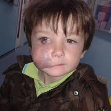 Young boy has dangerous toxins injected into his face to reduce 'massive  growth'