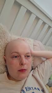 Tips to Relieve Back and Hip Pain from G-CSF Injections