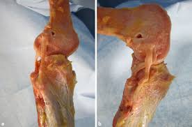 The knee tendons are thick cords that attach the bone to muscles. 8 Lateral Anatomy Of The Right Knee Of A Human Cadaver In A Extension Download Scientific Diagram