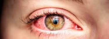 If you suddenly develop red eye, visit an. Rise And Shine To Bloodshot Eyes You Re Not Alone