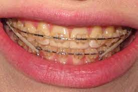 If you happen to deal with a lot of blood stains. Can Clear Braces Get Stained Orthodontists Weigh In Ncoso