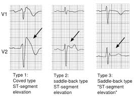 Brugada Syndrome Textbook Of Cardiology