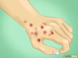 Deben ser tratados incluyendo sienes, frente y piel. Como Evitar Pegar Sarna 9 Passos Com Imagens Wikihow