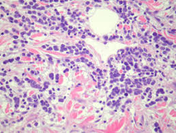 Biopsy must be performed to confirm the diagnosis. Merkel Cell Carcinoma Pathology Dermnet Nz