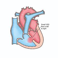 Image result for Ventricular Septal Defect