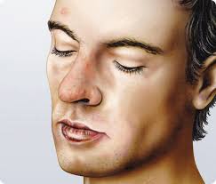 Check 'rhinophym' translations into english. Knollennase Behandlung Kosten Risiken Mooci