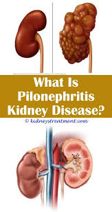 Kidney Disease Symptoms Watches Kidney Disease Polycystic Kidney Disease Kidney Disease Diet