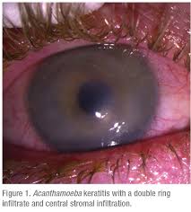 Signs and symptoms of keratitis include: Acanthamoeba The Keratitis That Won T Quit
