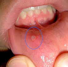 Antibakterielle präparate für den mundraum. Aphthe Wikipedia