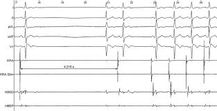 Sinus Node Disease In Subjects With Type 1 Ecg Pattern Of Brugada Syndrome Sciencedirect