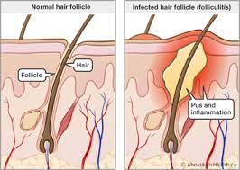 4 infected hair follicle symptoms 4.1 superficial folliculitis 4.2 deep folliculitis 4.3 hot tub folliculitis 1 4.1 superficial folliculitis 2 4.2 deep folliculitis 3 4.3 hot tub folliculitis. Folliculitis