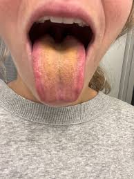 Image result for yellow tongue infection