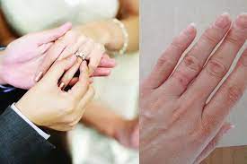 Everything You Must Know About Engagement Or Wedding Ring Allergy Wedding Ring Allergy Wedding Ring Rash Clean Wedding Rings