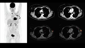 What does breast cancer look like on a mammogram? Fdg Pet Ct And Breast Cancer