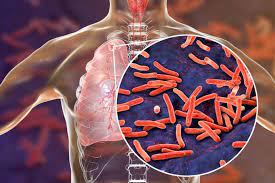 Лучшие жесткие диски для ноутбуков 2021. Tuberculosis Alone And With Hiv Co Infection Treatment Updates Pulmonology Advisor