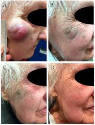 Image result for Merkel Cell Carcinoma