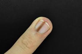 I sometimes get these splinter hemorrhages when my nail is. Longitudinal Melanonychia Causes And Risk Factors