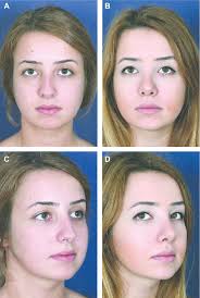 PDF] The lateral crural rein flap: a novel technique for management of tip  rotation in primary rhinoplasty.