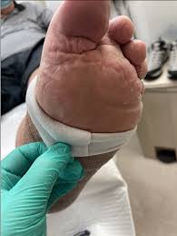 Image result for Probe-to-Bone Test