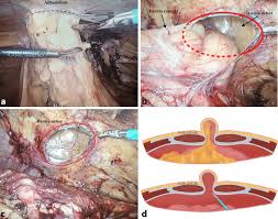 Image result for Hernia Reduction