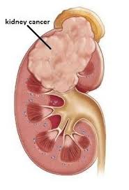 Bladder cancer signs and symptoms may include: Kidney Cancer Surgery Treatment In Gujarat India
