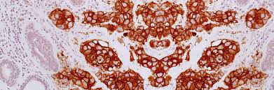 Brest) cancer is a common cancer among women. Types Of Breast Cancer Breast Pathology Johns Hopkins Pathology