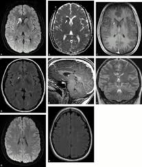 Acute And Chronic Brain Infarcts On Mr Imaging In A 20 Year Old Woman With Acute Posterior Multifocal Placoid Pigment Epitheliopathy American Journal Of Neuroradiology