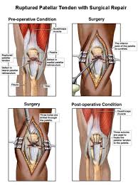 Great tension in the kneecap causes patellar tendonitis. Pin On Sports