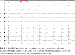 Gemeinsam ist ihnen ein unangemessen schneller puls von mehr als 100 schlägen in der minute und ein ursprung der. Management Supraventrikularer Tachykardien Kardiologie Gefassmedizin Universimed Medizin Im Fokus