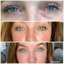 Lip flip &/or filler recommendations?