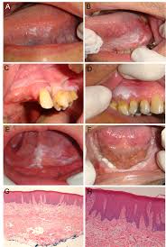 Leukoplakia of buccal mucosa removal by laser. Oral Hpv Related Diseases A Review And An Update Intechopen