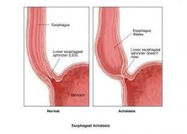 Achalasia Symptoms Difficulty Swallowing Food And Liquids Difficulty Swallowing Food Difficulty Swallowing Swallowing Problems