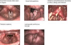 Image result for Functional Aphonia